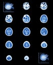 CT scan (computed tomography) of normal brain ( cerebrovascular Royalty Free Stock Photo