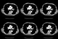 Computed tomography CT whole abdomen in Axial. Part three