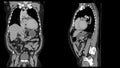 CT Scan Computed tomography of whole abdomen with contrast. Coronal and Sagittal view presented with clinical history of cervi