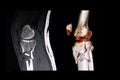 CT scan and 3D computer rendering images of a knee Royalty Free Stock Photo