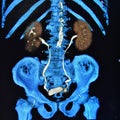 Ct scan 3d ct urography kidneys bladder colorful Royalty Free Stock Photo