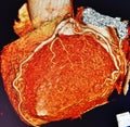 Ct scan 3d heart angiography colorful