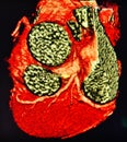 Ct scan 3d heart angiography colorful