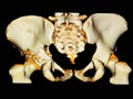 CT-scan 3D Pelvis