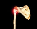 CT scan 3D rendering of shoulder joint showing fracture head of humerus