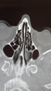 CT scan of the ethmoid sinus air cells