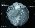 CT-Scan Heart