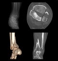 CT Scan image of Left Ankle Shown fracture of Left Ankle .