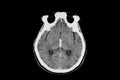 CT scan intracerebral hemorrhage Royalty Free Stock Photo