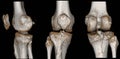 CT scan knee Fracture of intercondylar eminence of tibia. Compression fracture of posterior of lateral tibial plateau which Royalty Free Stock Photo