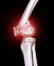 CT scan of knee joint 3D rendering image  showing fracture of distal femur bone Royalty Free Stock Photo