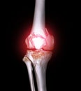 CT scan of knee joint 3D rendering image showing fracture of distal femur bone