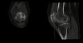 CT Scan of Knee joint sagittal and coronal in case fracture patella bone Royalty Free Stock Photo