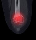 CT scan of knee joint showing fracture of distal femur bone