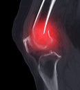 CT scan of knee joint showing fracture of distal femur bone