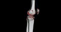 CT Scan of Knee joint showing fracture tibia and fibula bone 3D rendering Royalty Free Stock Photo