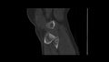 CT Scan knee of the patient periarticular injuries fracture of the proximal tibia frequently associated with soft tissue injuries.