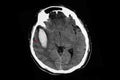 CT scan of a large intracerebral hemorrhge of the brain