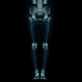 CT scan of lower extremity ,3D illustration of Femur bone , knee joint , leg and foot