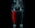 CT scan of lower extremity ,3D illustration of Femur bone , knee joint , leg and foot