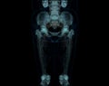 CT scan of lower extremity ,3D illustration of Femur bone , knee joint , leg and foot