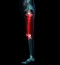 CT scan of lower extremity ,3D illustration of Femur bone , knee joint , leg and foot