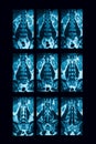 CT-scan of lumbar spine, case of lumbar spondylosis Royalty Free Stock Photo