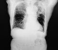 Ct scan lung cavitary mass malignancy