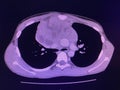 CT scan mass at interior mediastinum