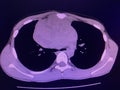 CT scan mass at interior mediastinum