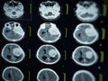 CT scan and MRI of brain : show cerebral infarct , intracerebral hemorrhage