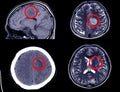 CT Scan of Brain showing Intracerebral Haemorrhage - Axial View Royalty Free Stock Photo