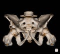 CT Scan Pelvis Bone 3D rendering image isolated on black background showing There is a 8mm thick and 5cm long tubular ossification