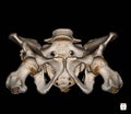 CT Scan Pelvis Bone 3D rendering image isolated on black background showing There is a 8mm thick and 5cm long tubular ossification