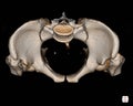 CT Scan Pelvis Bone 3D rendering image isolated on black background showing There is a 8mm thick and 5cm long tubular ossification