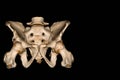 CT Scan of Pelvis 3D rendering image.showing :Myositis ossifican at muscle superolateral to right acetabulum.on Black background.