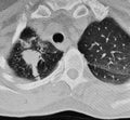 Ct scan right lung lower lobe carcinoma.