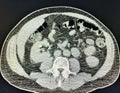 Ct scan right renal cyst collapse after drainage imaging