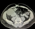 Ct scan right renal cyst preoperative imaging