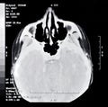 CT Scan Segment