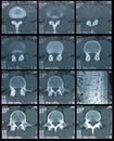 CT Scan of spine Royalty Free Stock Photo