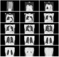 Ct scan step set of body lung coronal view