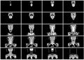 Ct scan step set of neck coronal view
