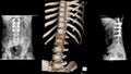 CT Scan Thoracic spine ct with 3D reconstruction . The film shown thoracolumbar injury after fall form height. Dark background