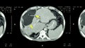 CT scan of upper abdomen : show abnormal mass at liver ( Liver cancer )