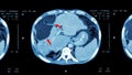 CT scan of upper abdomen : show abnormal mass at liver ( Liver cancer )