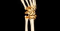 CT scan of wrist joint 3D rendering for diagnosis wrist joint pain
