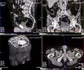 CT scans of human spine