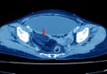 CT Whole abdomen finding fatty mass with calcification at Rt adnexa, representing dermoid cyst