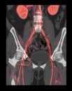 CTA ABDOMINAL AORTA 3D rendering image .